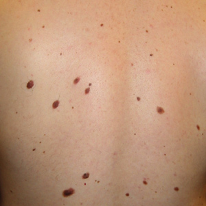 Melanomen zijn vaak niet gepigmenteerd! | Dr. Velthuis blog Melanomen zijn vaak niet gepigmenteerd! | Dr. Velthuis blog